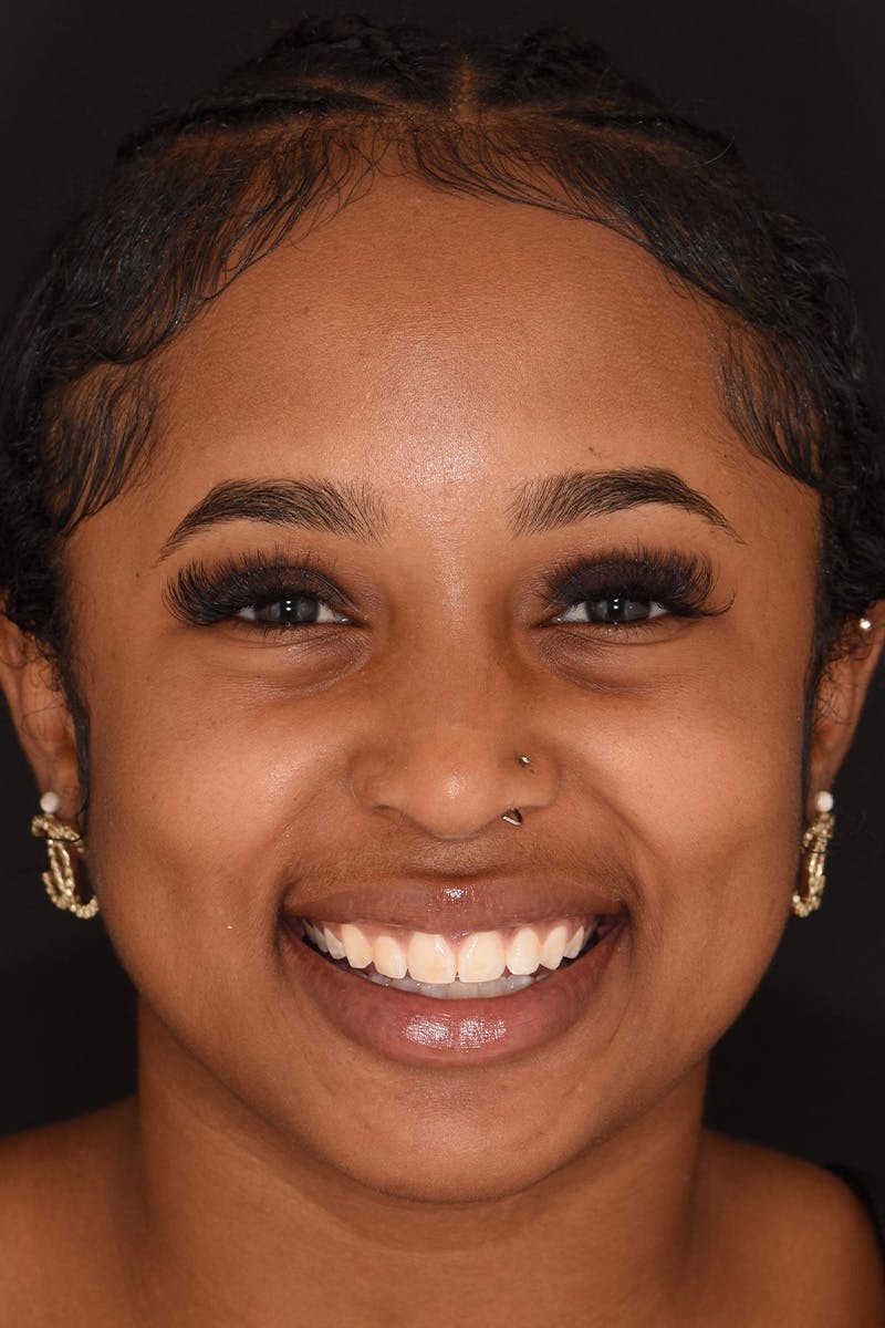 Patient Smile Before & After Gallery - Patient 271095 - Image 1