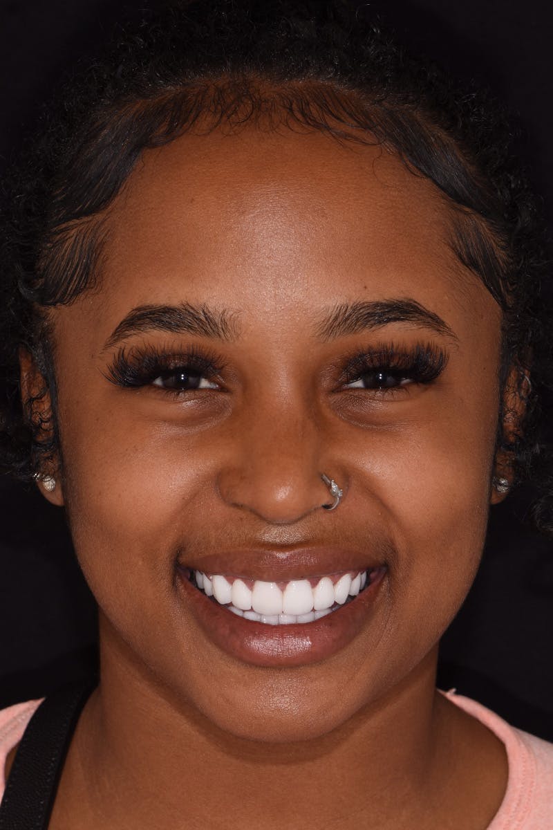 Patient Smile Before & After Gallery - Patient 271095 - Image 2