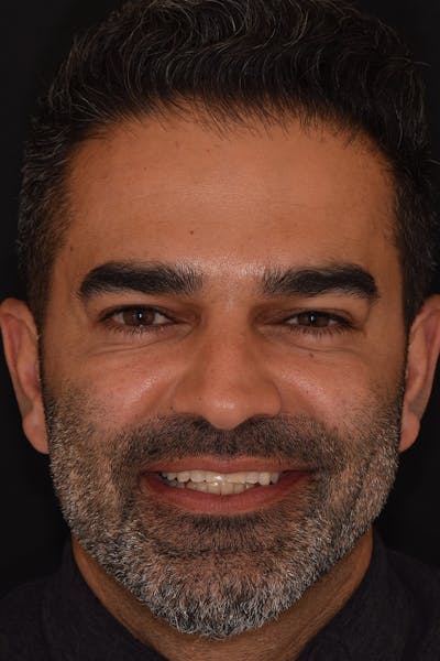 Patient Smile Before & After Gallery - Patient 104193 - Image 1