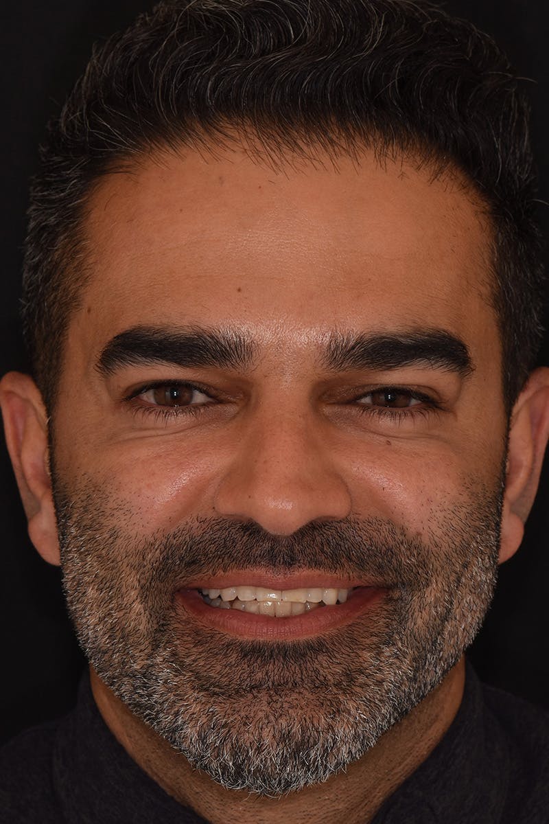 Patient Smile Before & After Gallery - Patient 104193 - Image 1