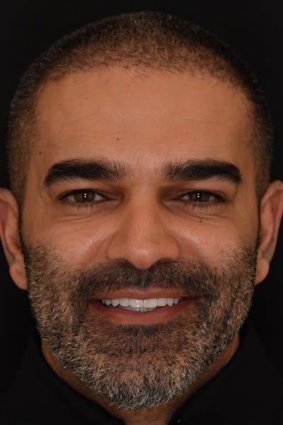 Patient Smile Before & After Gallery - Patient 104193 - Image 2