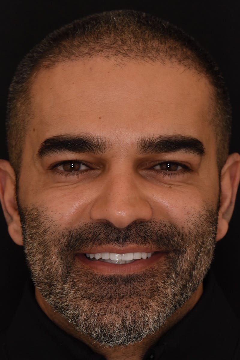 Patient Smile Before & After Gallery - Patient 104193 - Image 2