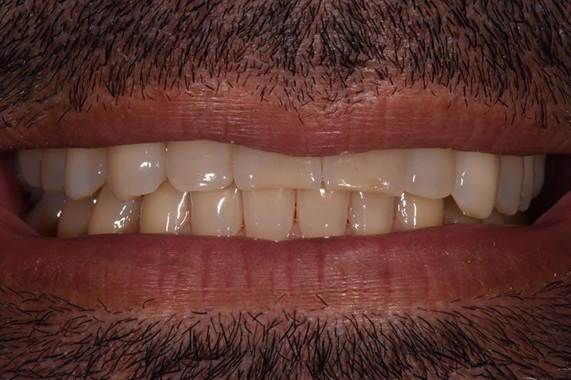 Patient Smile Before & After Gallery - Patient 104193 - Image 3
