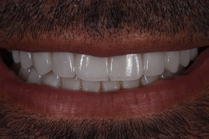 Patient Smile Before & After Gallery - Patient 104193 - Image 4