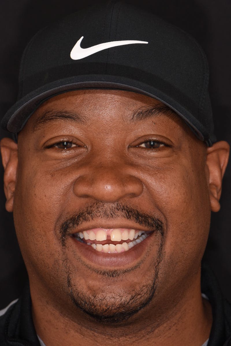 Patient Smile Before & After Gallery - Patient 396220 - Image 1