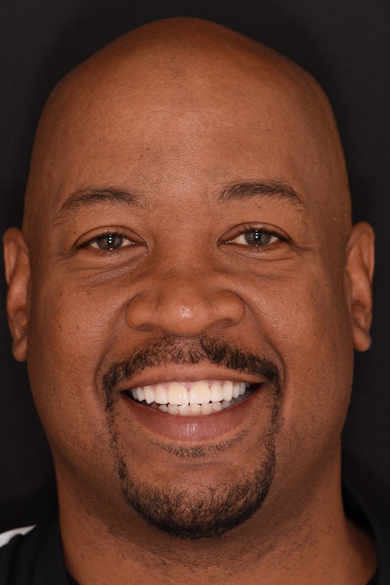 Patient Smile Before & After Gallery - Patient 396220 - Image 2