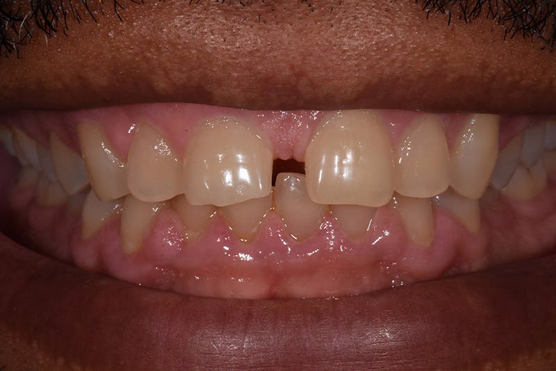 Patient Smile Before & After Gallery - Patient 396220 - Image 3