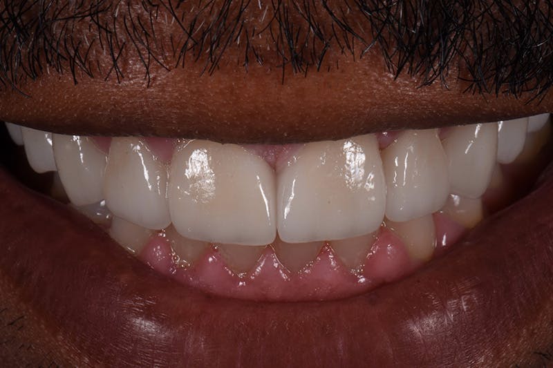 Patient Smile Before & After Gallery - Patient 396220 - Image 4