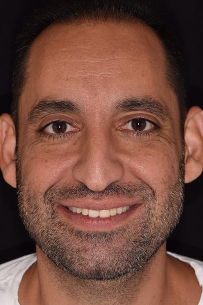 Patient Smile Before & After Gallery - Patient 115536 - Image 1