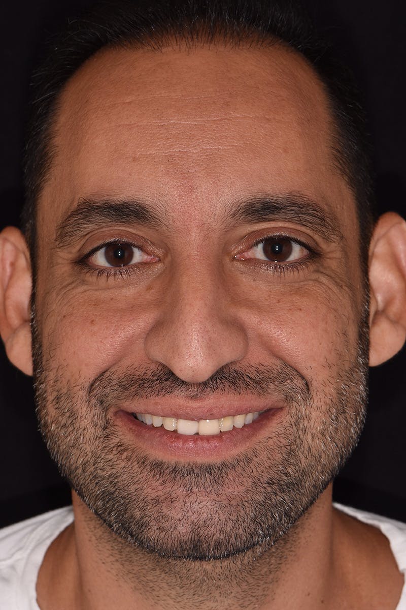 Patient Smile Before & After Gallery - Patient 115536 - Image 1