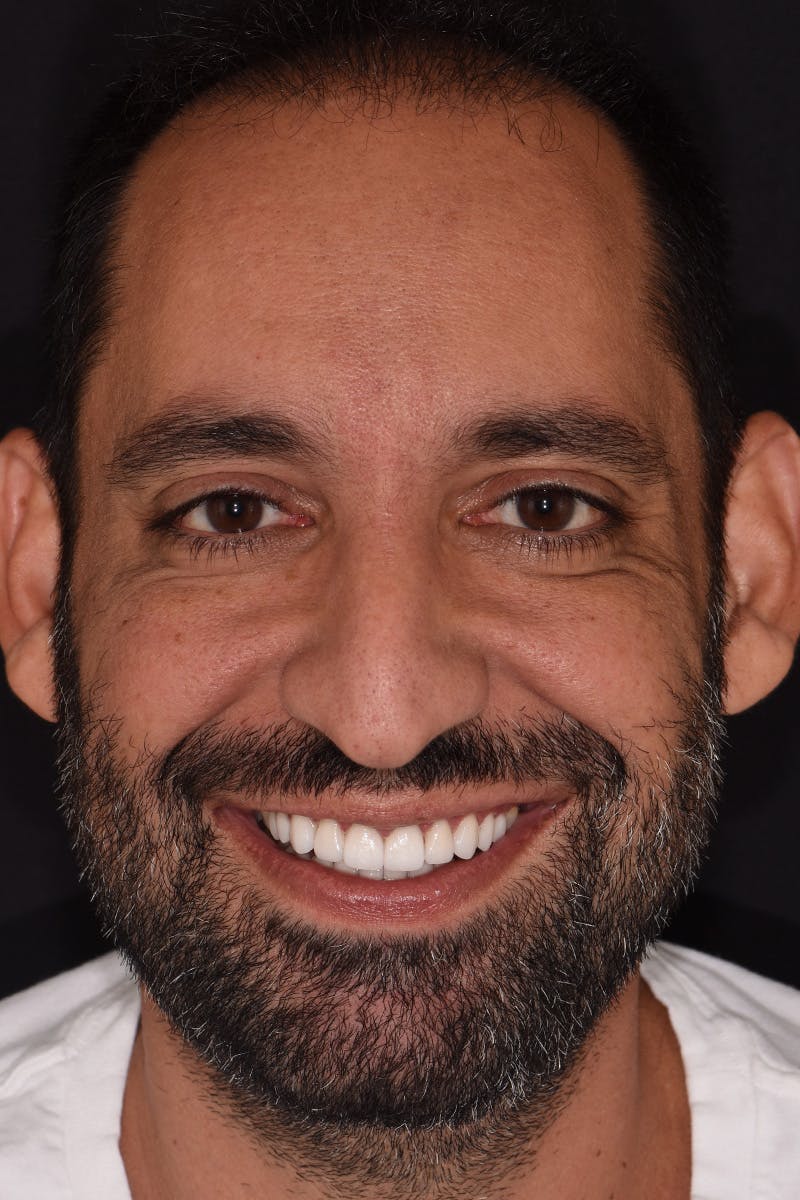 Patient Smile Before & After Gallery - Patient 115536 - Image 2