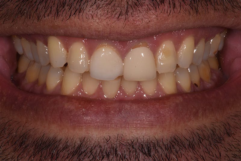 Patient Smile Before & After Gallery - Patient 115536 - Image 3