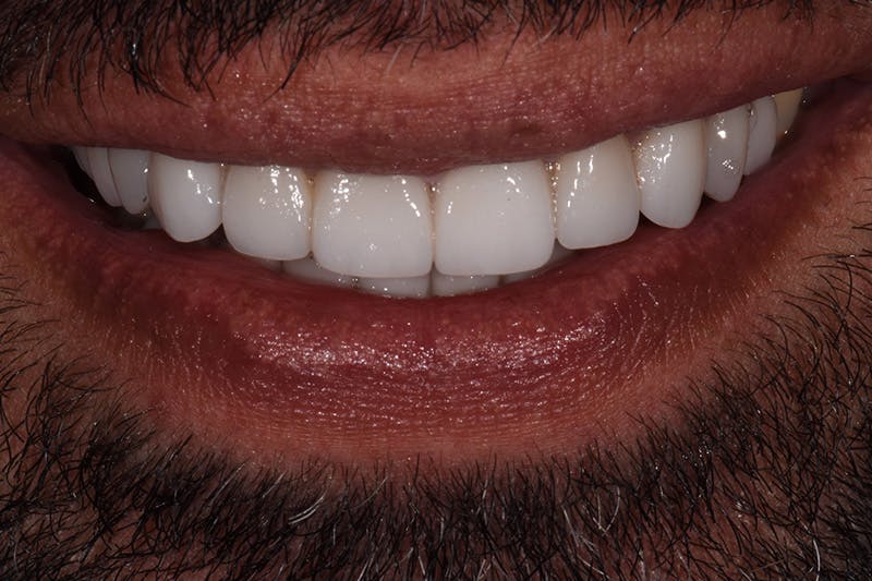 Patient Smile Before & After Gallery - Patient 115536 - Image 4