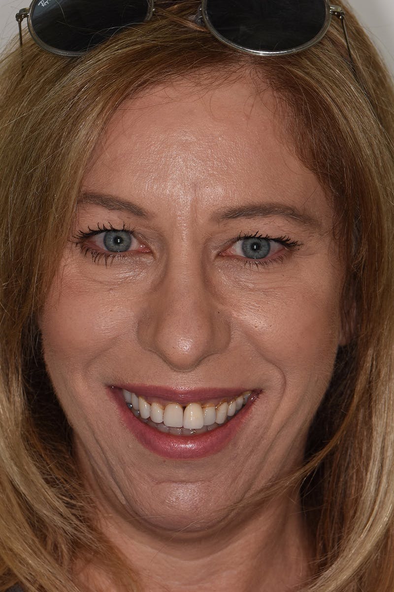 Patient Smile Before & After Gallery - Patient 148137 - Image 1