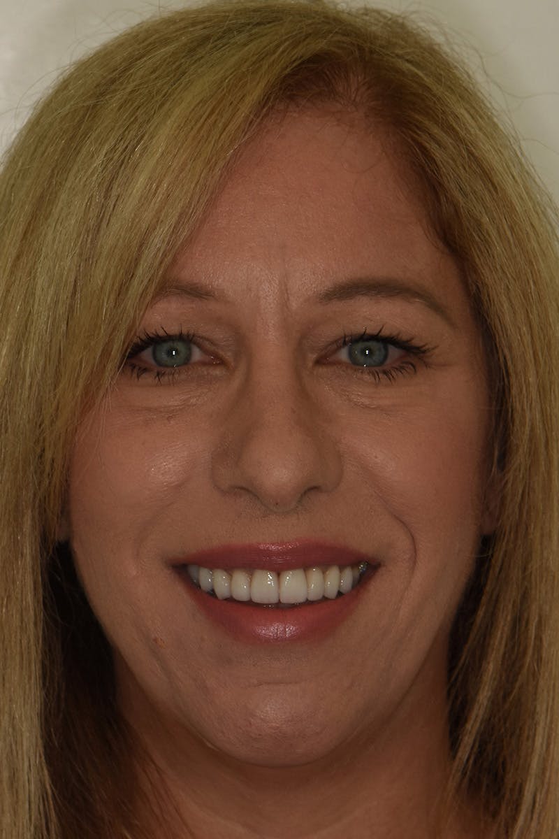 Patient Smile Before & After Gallery - Patient 148137 - Image 2