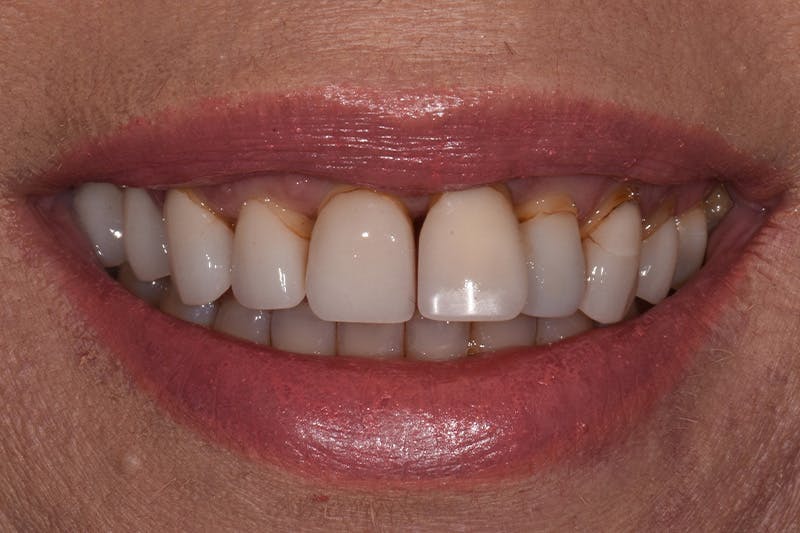 Patient Smile Before & After Gallery - Patient 148137 - Image 3