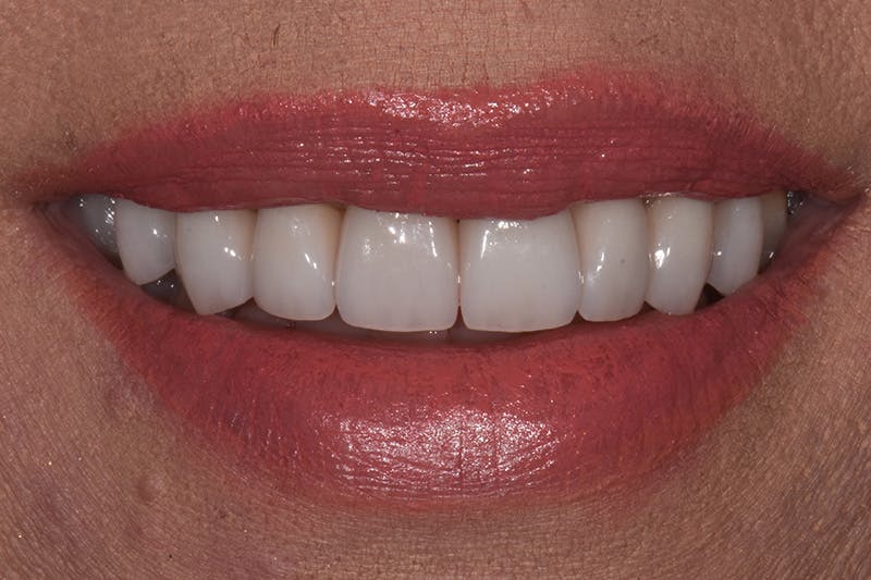 Patient Smile Before & After Gallery - Patient 148137 - Image 4