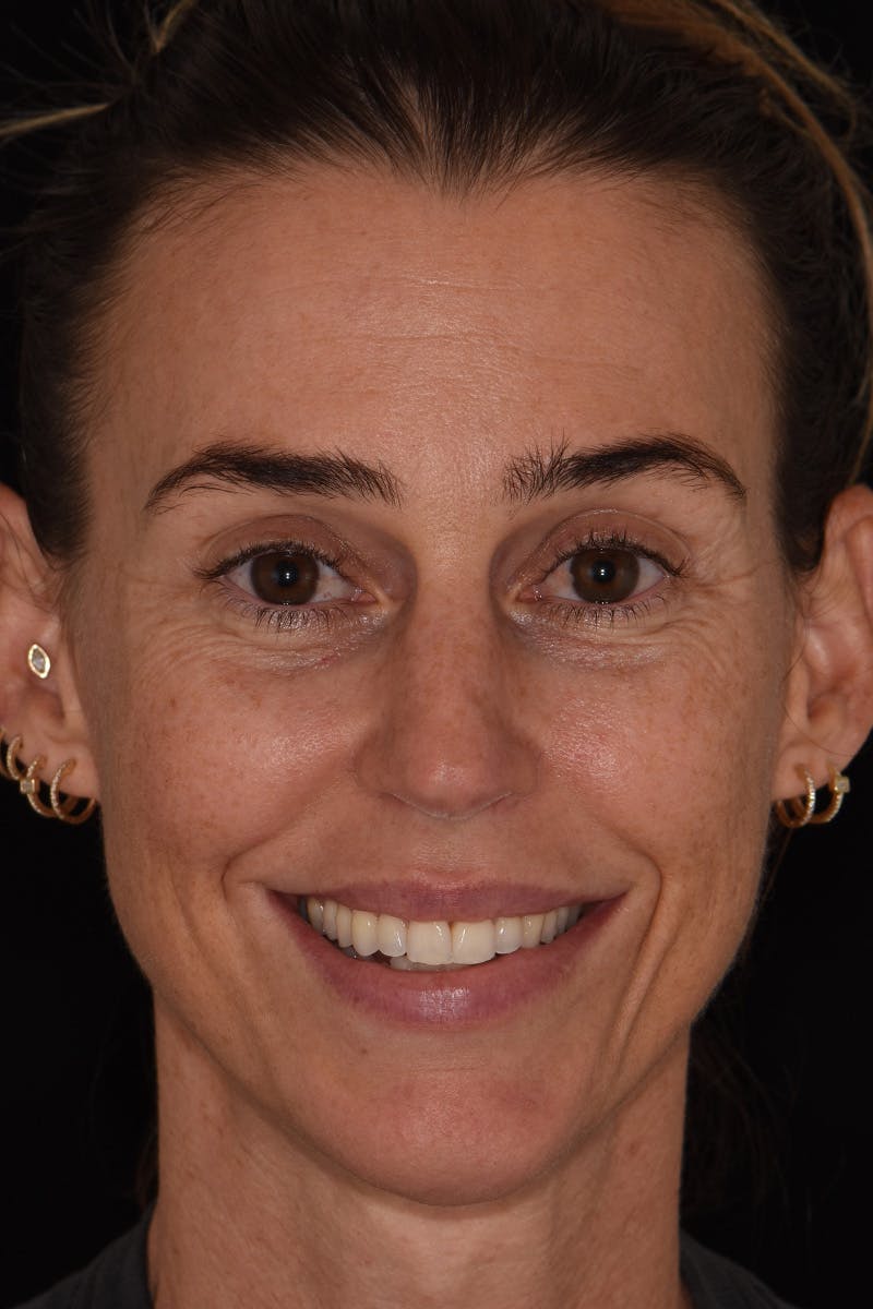 Patient Smile Before & After Gallery - Patient 249307 - Image 1
