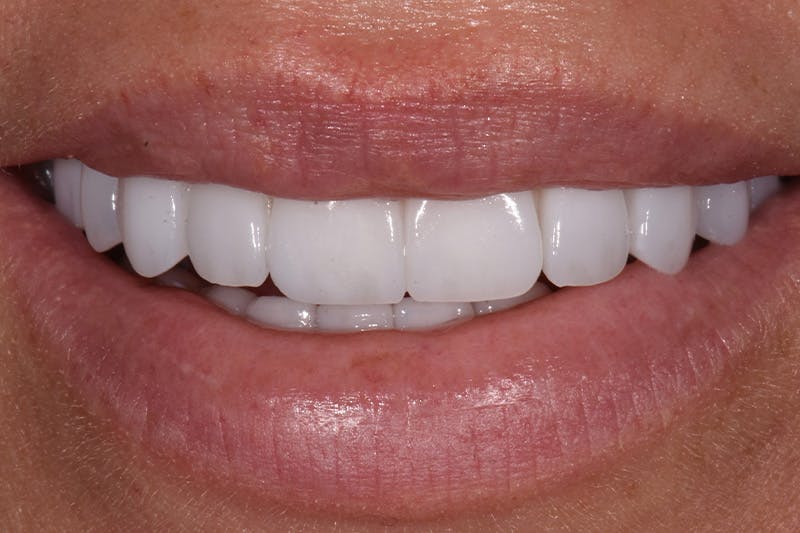 Patient Smile Before & After Gallery - Patient 249307 - Image 4