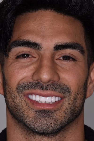 Patient Smile Before & After Gallery - Patient 382658 - Image 2