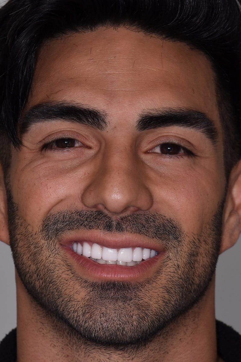 Patient Smile Before & After Gallery - Patient 382658 - Image 2