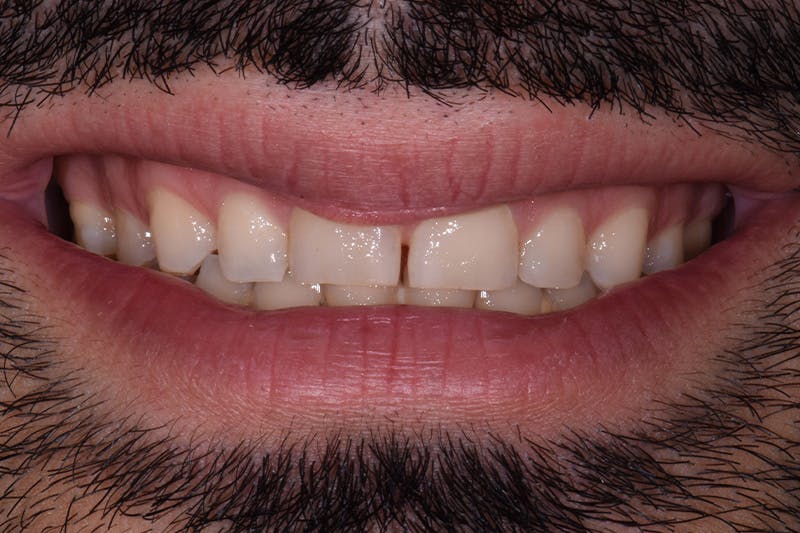 Patient Smile Before & After Gallery - Patient 382658 - Image 3
