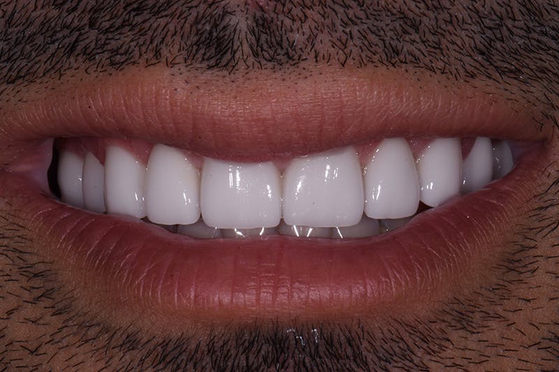 Patient Smile Before & After Gallery - Patient 382658 - Image 4