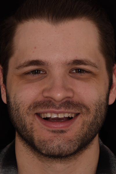 Patient Smile Before & After Gallery - Patient 154356 - Image 1