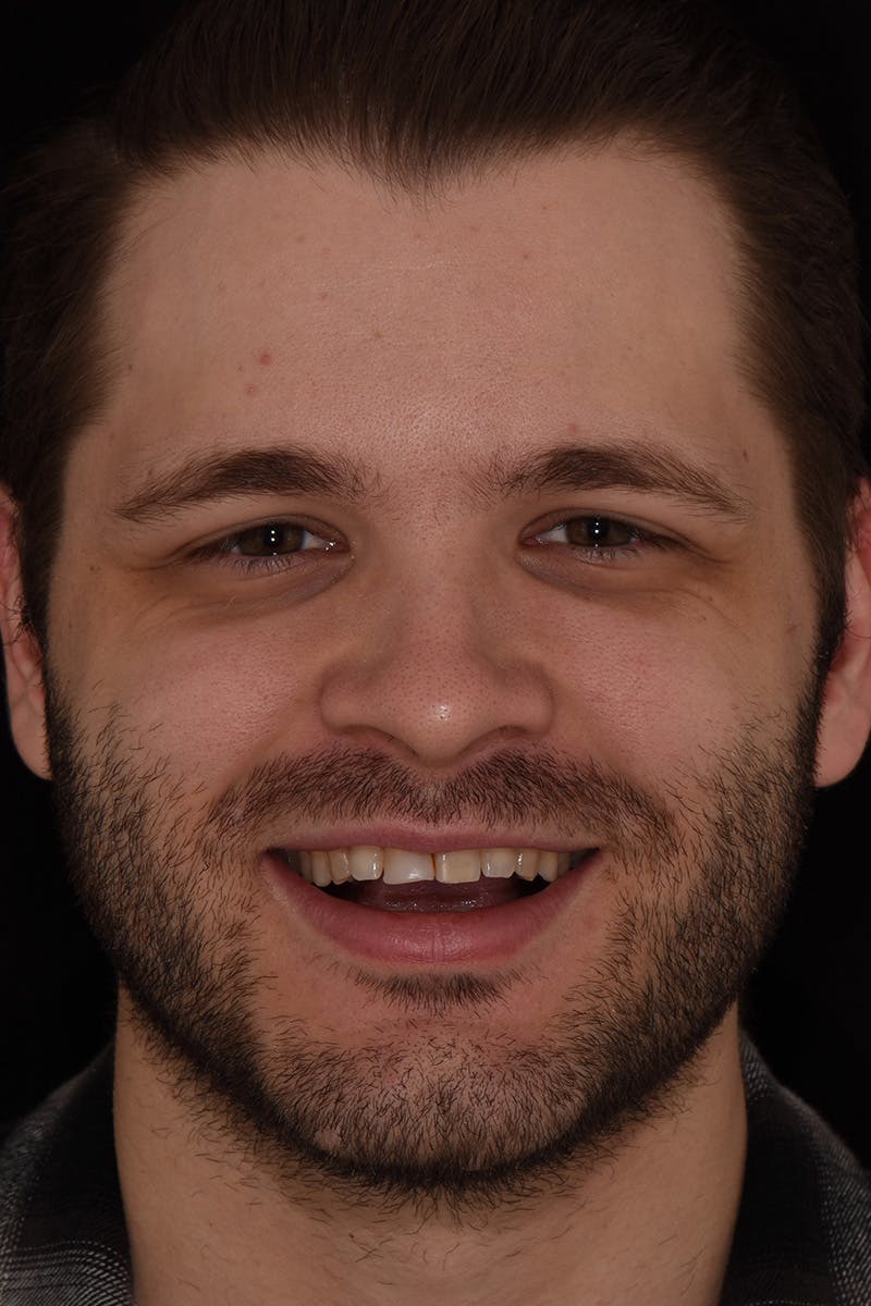 Patient Smile Before & After Gallery - Patient 154356 - Image 1