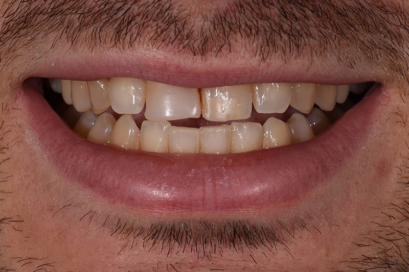 Patient Smile Before & After Gallery - Patient 154356 - Image 3