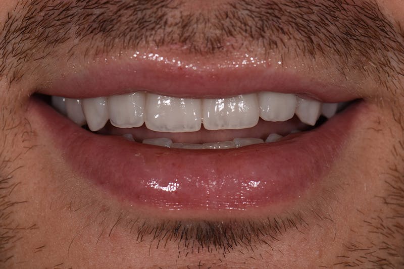 Patient Smile Before & After Gallery - Patient 154356 - Image 4
