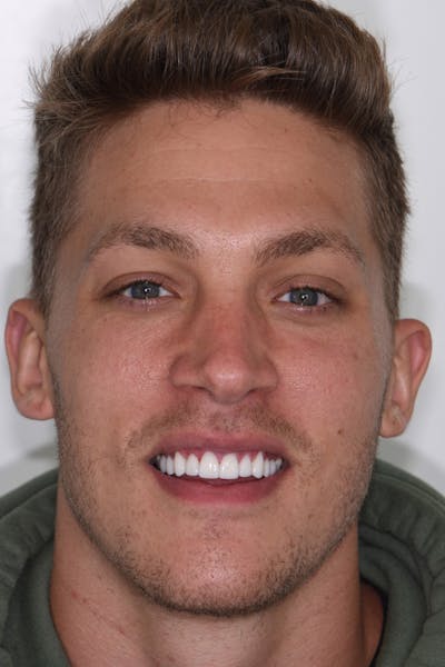 Patient Smile Before & After Gallery - Patient 404042 - Image 2