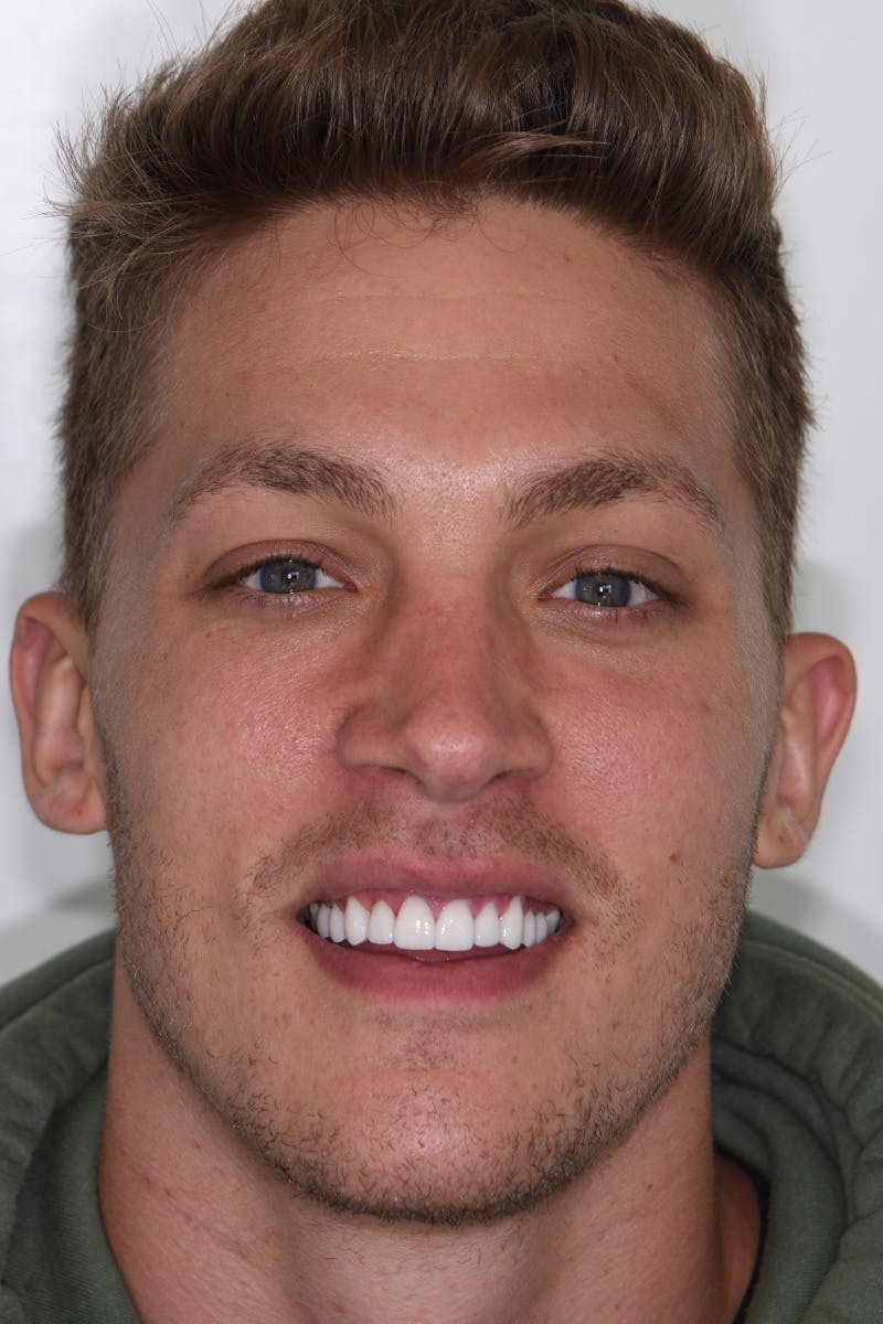 Patient Smile Before & After Gallery - Patient 404042 - Image 2