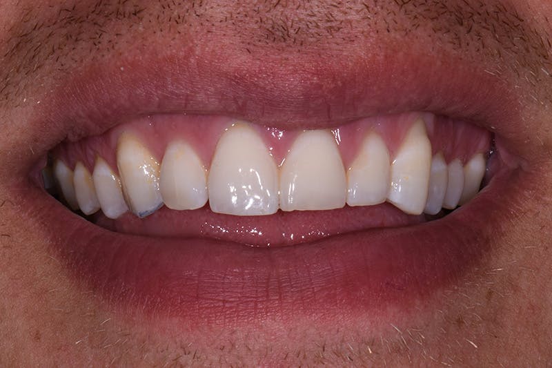 Patient Smile Before & After Gallery - Patient 404042 - Image 3
