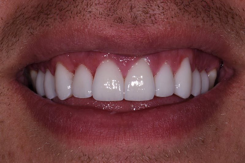 Patient Smile Before & After Gallery - Patient 404042 - Image 4