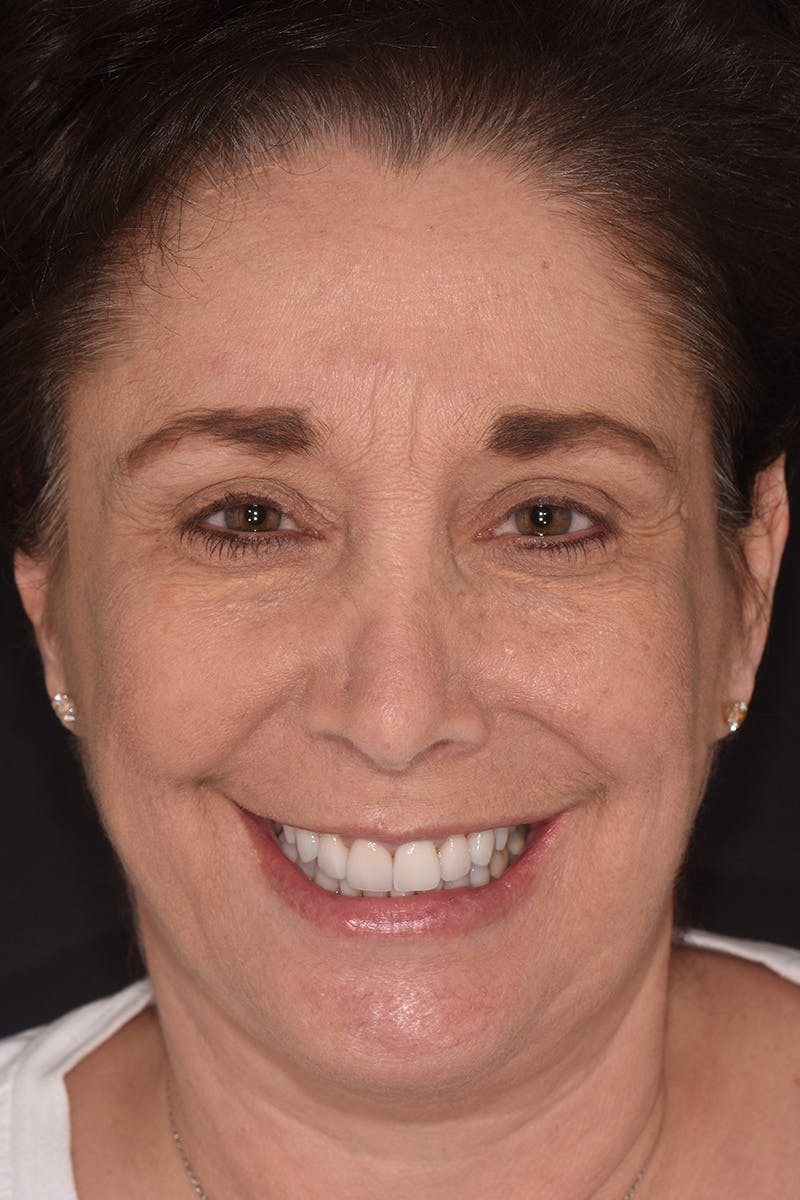 Patient Smile Before & After Gallery - Patient 282765 - Image 2