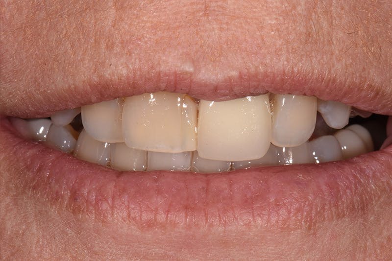 Patient Smile Before & After Gallery - Patient 282765 - Image 3