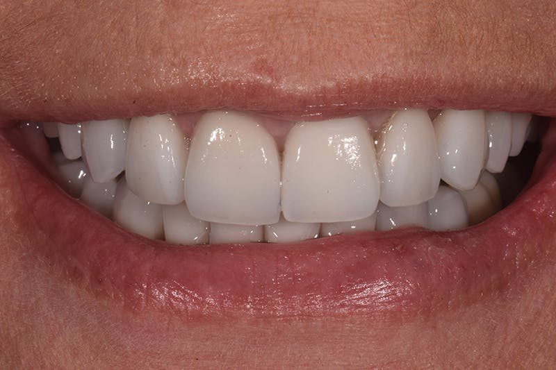 Patient Smile Before & After Gallery - Patient 282765 - Image 4