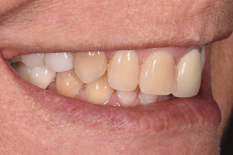 Patient Smile Before & After Gallery - Patient 282765 - Image 5