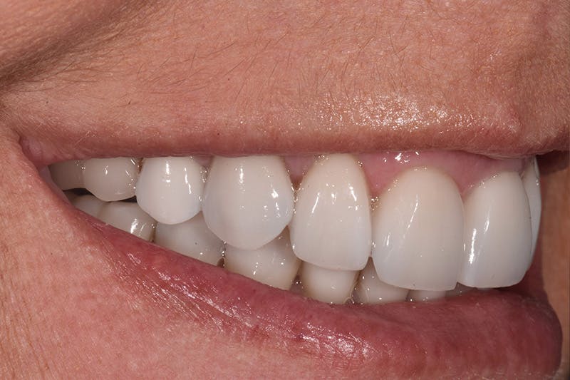 Patient Smile Before & After Gallery - Patient 282765 - Image 6