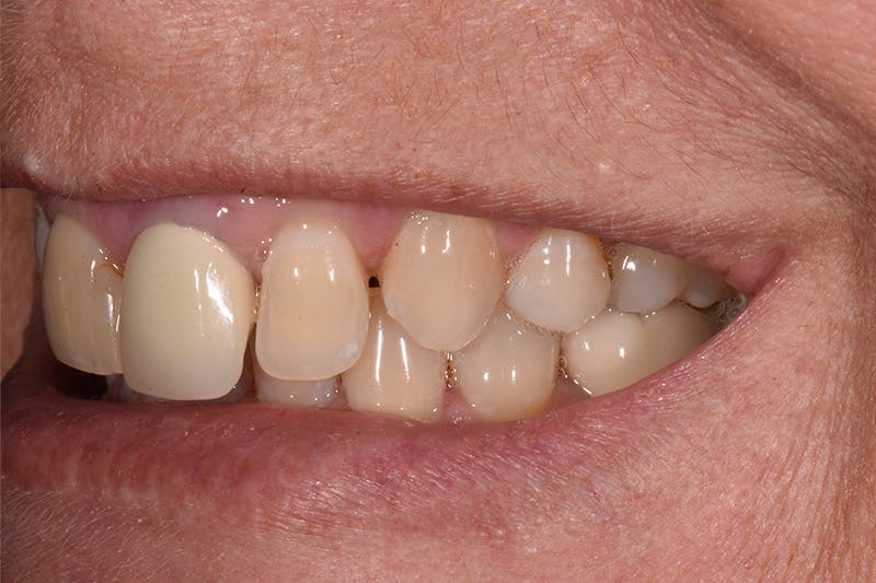Patient Smile Before & After Gallery - Patient 282765 - Image 7