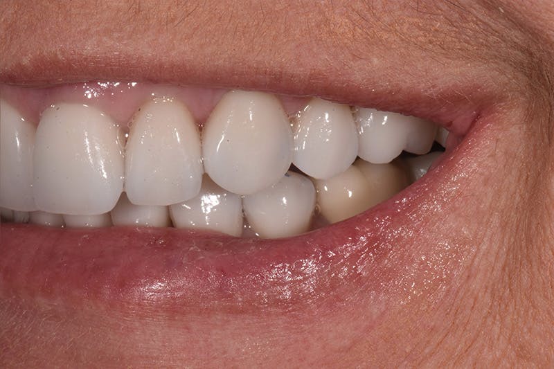 Patient Smile Before & After Gallery - Patient 282765 - Image 8