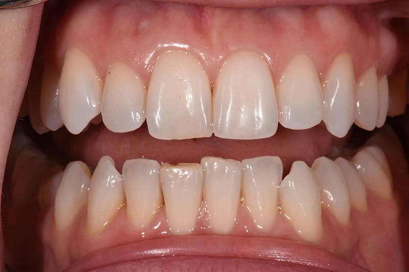 Patient Smile Before & After Gallery - Patient 877040 - Image 1