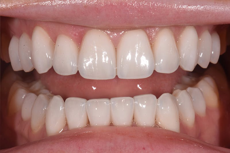 Patient Smile Before & After Gallery - Patient 877040 - Image 2