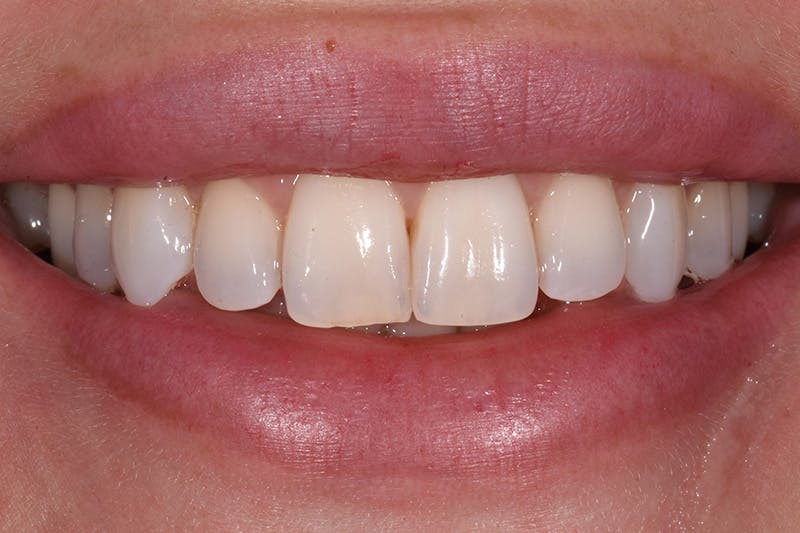 Patient Smile Before & After Gallery - Patient 877040 - Image 3