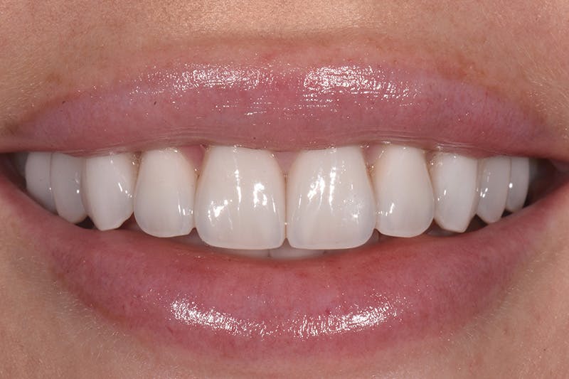Patient Smile Before & After Gallery - Patient 877040 - Image 4