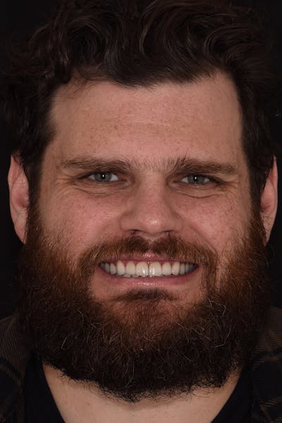 Patient Smile Before & After Gallery - Patient 375478 - Image 2