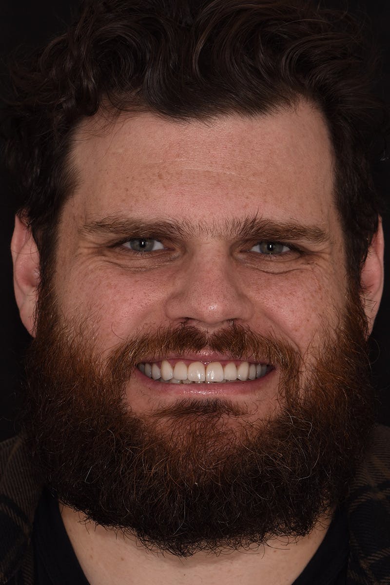 Patient Smile Before & After Gallery - Patient 375478 - Image 2