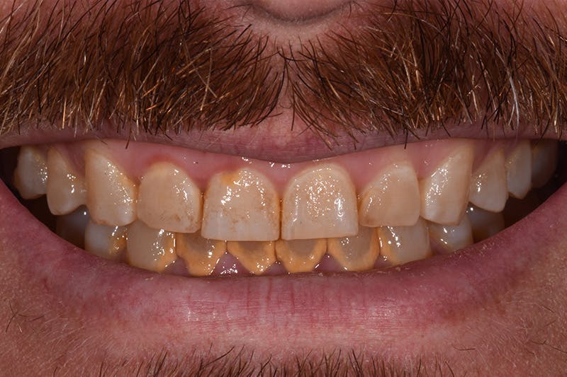 Patient Smile Before & After Gallery - Patient 375478 - Image 3