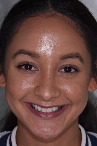 Patient Smile Before & After Gallery - Patient 271730 - Image 1